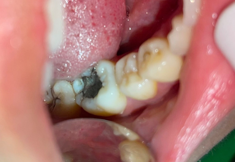 Hàn răng sâu xong bị đau nhức